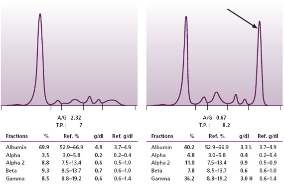 Figure 2. Normal SPE on left. SPE with an M protein on the right.