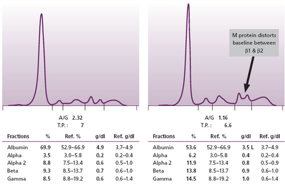 Figure 3. Normal SPE on left. On the right is an SPE with a small M protein that has resulted in an 
         increased baseline (a bridge) between the two normal beta region bands. At Warde Medical Laboratory, 
         such patterns are reflexed to serum immunofixation (IFE) to demonstrate the M proteins.