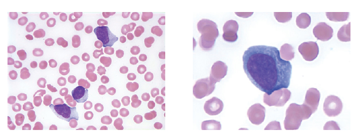 Warde Medical Laboratory: A National Reference Lab - Figure 1. Reactive lymphocyte morphology in a patient with acute infectious mononucleosis caused by EBV. 